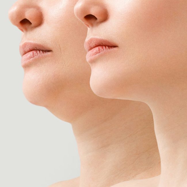 Double Chin Treatment 7 Double Chin