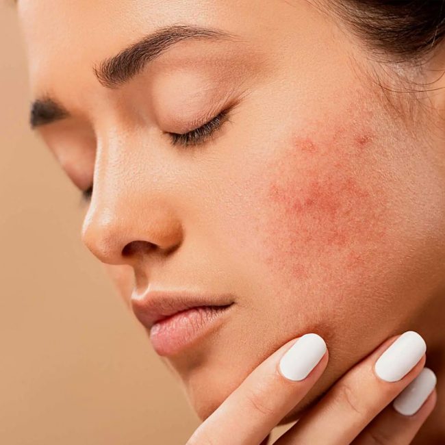 Acne Scar 5 05 Acne Scar 01