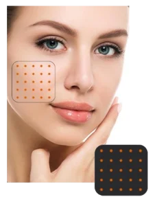 microneedling pinxel v