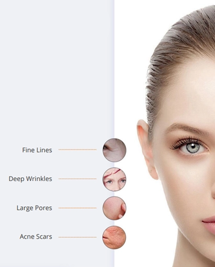 advanced microneedling pinxel v